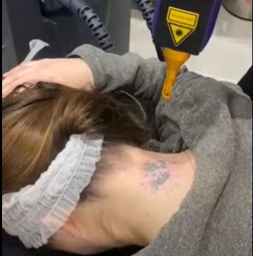 Eliminación de Tatuaje | Por medidas
